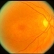 Chloroquine Toxicity Chloroquine Toxicity