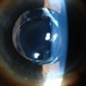 Accordioning Crystalline Lens