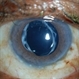 Accordioning Crystalline Lens