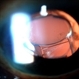 Accordioning Crystalline Lens