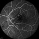 Radiation Maculopathy Radiation Maculopathy