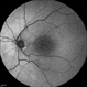 Radiation Maculopathy Radiation Maculopathy