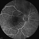 Radiation Maculopathy Radiation Maculopathy