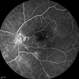 Radiation Maculopathy