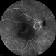 Radiation Maculopathy Radiation Maculopathy