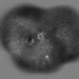Radiation Maculopathy Radiation Maculopathy