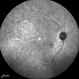 Fundus Flavimaculatus and CNV Fundus Flavimaculatus and CNV