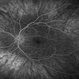 Ocular Albinism