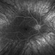 Ocular Albinism Ocular Albinism