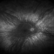 Ocular Albinism