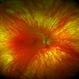 Ocular Albinism