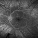 Ocular Albinism Ocular Albinism