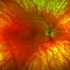 Ocular Albinism Ocular Albinism
