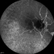 Angioid Streaks Angioid Streaks