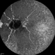 Angioid Streaks Angioid Streaks