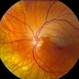 Arterial Occlusion