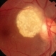 Astrocytoma Astrocytoma