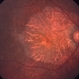 Geographic Atrophy, Fundus photograph Geographic Atrophy, Fundus photograph