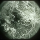 Proliferative Diabetic Retinopathy Proliferative Diabetic Retinopathy