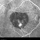 Choroidal Neovascularization with Subretinal Hemorrhage Choroidal Neovascularization with Subretinal Hemorrhage