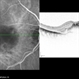 Subretinal Hemorrhage in Wet AMD Subretinal Hemorrhage in Wet AMD