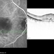Retinal Angiomatous Proliferation