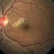 Branch Retinal Artery Occlusion