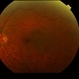 Choroidal Nevus Choroidal Nevus