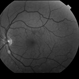 Choroidal Nevus Choroidal Nevus