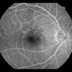 Branch Retinal Vein Occlusion