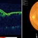 Branch Retinal Vein Occlusion (BRVO) Branch Retinal Vein Occlusion (BRVO)