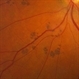 Bear Tracks Pigmentation Bear Tracks Pigmentation