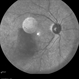Behcet's Disease Behcet's Disease