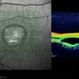 Best Disease Best Disease