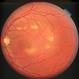 Bests Disease  Multi Focal OS Bests Disease  Multi Focal OS