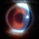 Blood in the Anterior Chamber