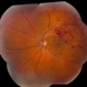 Branch Retinal Vein Occlusion
