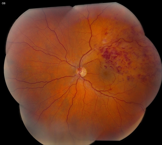 Branch retinal vein occlusion retina image bank