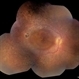 Bull's Eye Maculopathy