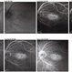Bulls eye retinopathy FA LE Bulls eye retinopathy FA LE