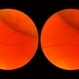 Scleral Indentation In A Normal Eye Scleral Indentation In A Normal Eye