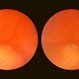 White Retinal Tuft