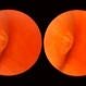Meridional Fold Meridional Fold