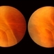 Pseudo Retinal Break Pseudo Retinal Break