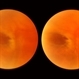 Pseudo Retinal Break Pseudo Retinal Break