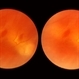 Pseudo Retinal Break Pseudo Retinal Break