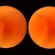Scleral Indentation Scleral Indentation