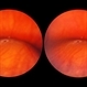 White Retinal Tuft White Retinal Tuft