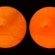 Scleral Indentation Scleral Indentation