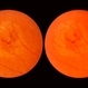Laser Photocoagulation Laser Photocoagulation